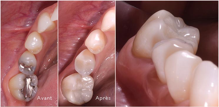 obturation en composite avant et après