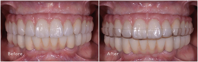 Occlusal Splints Before After