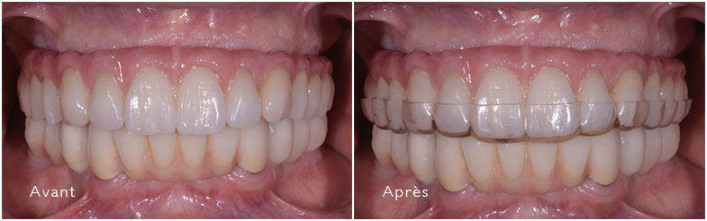 Plaques occlusales avant et après