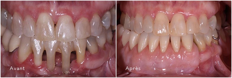 Prothèses partielles avant et après