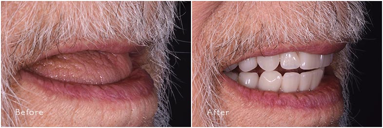 Upper and Lower Dentures