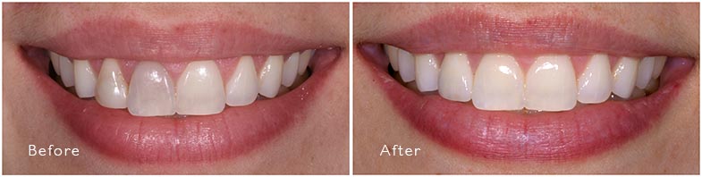 Single Crown and Internal Bleach